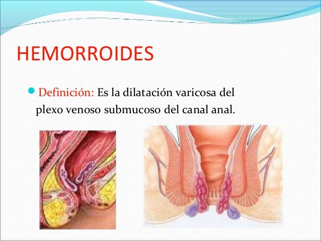hemorroidectomia tecnica quirurgica